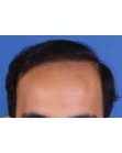 After Hair Transplant &nbsp;Front